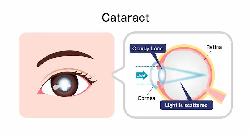 Cataract Surgery Advanced Lenses